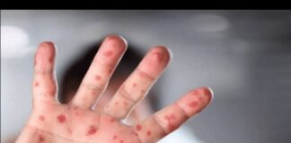 Aruba no tin caso di Monkeypox