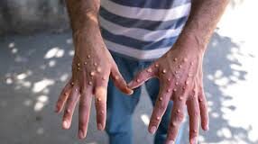 Prome caso di Monkeypox na Aruba