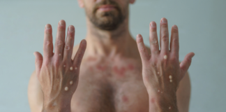 Minister Dangui Oduber; ARUBA TA CONOCE SU PROME CASO POSITIVO DI MONKEYPOX