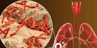 Alarma na Venezuela pa tuberculosis cu ta mas y mas presente cerca mucha