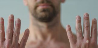 Mpox declara un estado di emergencia pa salud publico cu preocupacion internacional