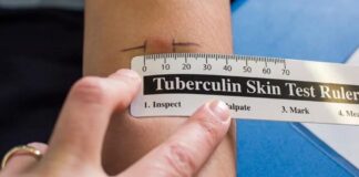 DVG ta haci un yamada: Na tur es cu falta pa haci nan Tuberculosis test pa presenta