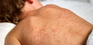 Biahando e semana santa aki? Atencion pa casonan di sarampi aumentando mundialmente