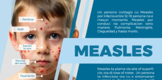Con Measles (sarampi) ta transmiti su mes