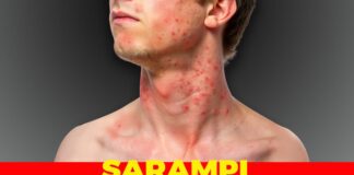 DVG ta informa Caso di Sarampi conoci na Boneiro tawata di transito na Aruba