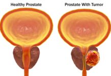CANCER DI PROSTATA Y E TEST DI SANGER PSA: Dicon hopi homber ta yega dokter demasiado lat?