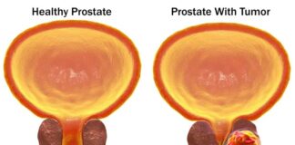 CANCER DI PROSTATA Y E TEST DI SANGER PSA: Dicon hopi homber ta yega dokter demasiado lat?