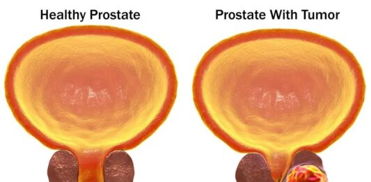CANCER DI PROSTATA Y E TEST DI SANGER PSA: Dicon hopi homber ta yega dokter demasiado lat?