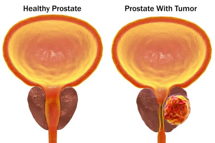 prostate